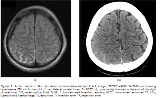 Chẩn đoán phân biệt tăng tín hiệu dịch não tủy trên ảnh FLAIR của não