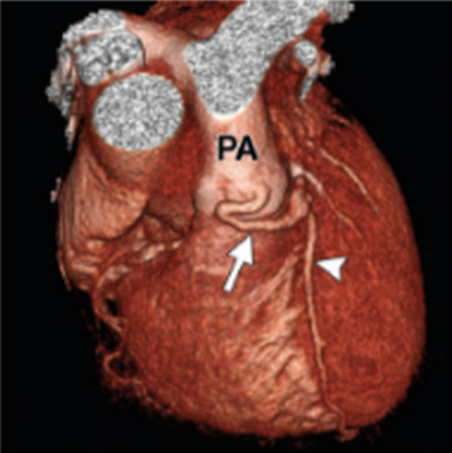 Anatomy and Anomalies of the Coronary artery at MSCT: What the Radiologist need to know?