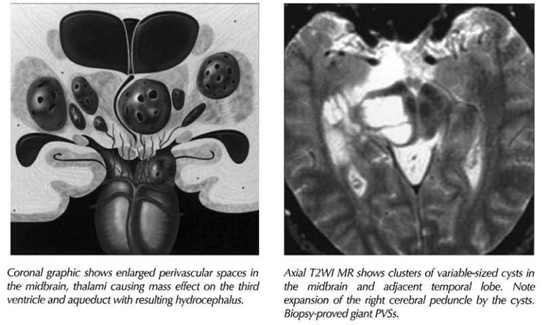 Các tổn thương dạng nang nội sọ trên MRI và CLVT