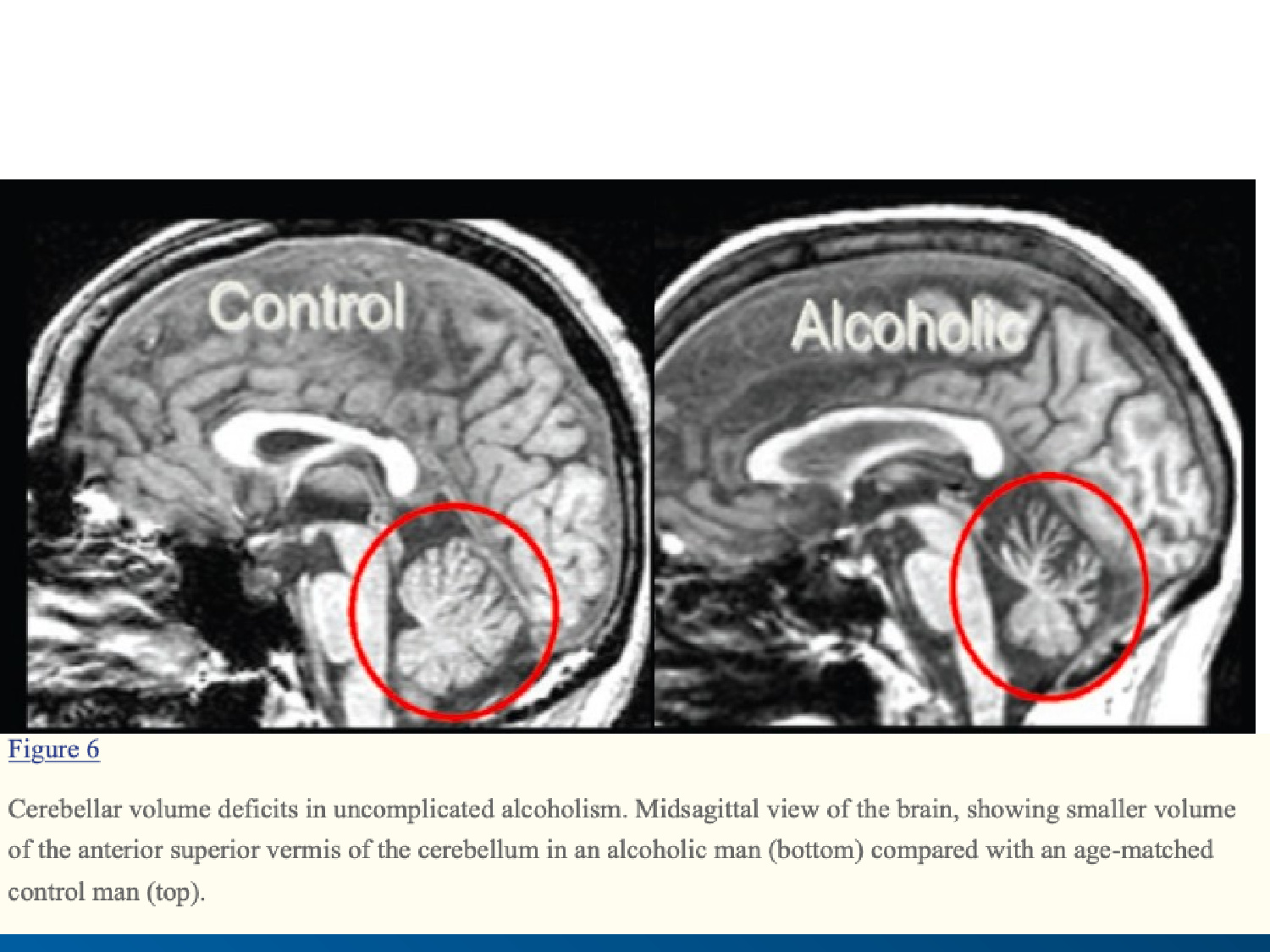 NEUROIMAGING FINDINGS IN ALCOHOL-RELATED ENCEPHALOPATHIES