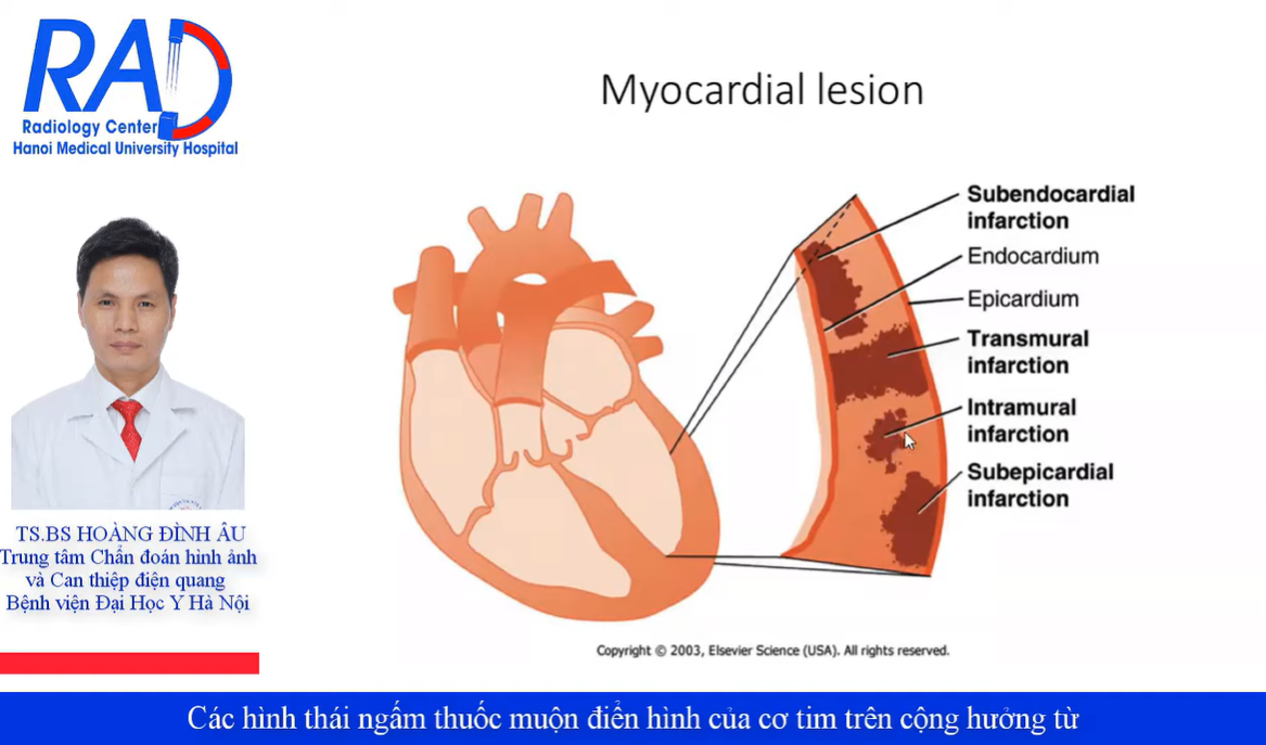 Các hình thái NGẤM THUỐC MUỘN điển hình của cơ tim trên cộng hưởng từ